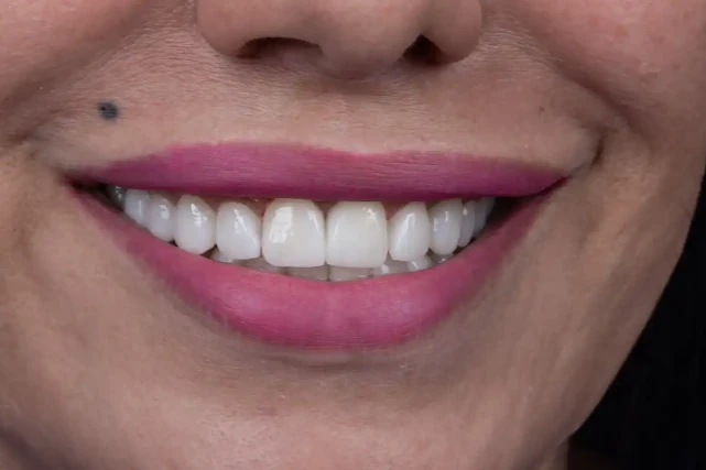 Vorher Porzellan-Zahnveneer Tunesien – vergilbte und abgebrochene Zähne Patient VIP Smile